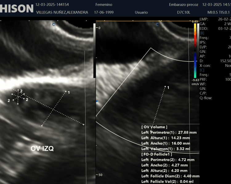 Ecografía Ginecológica