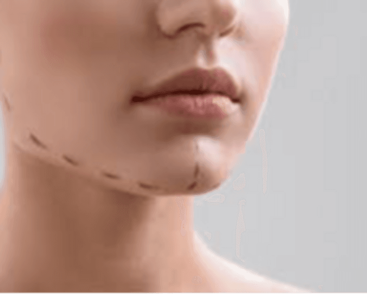 Mentoplastia con ac. Hialurónico