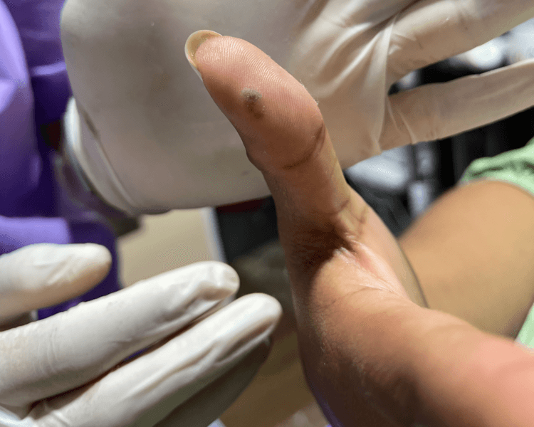 Cauterización de verrugas