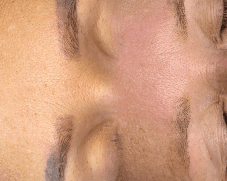 Eliminación de micropigmentacion
