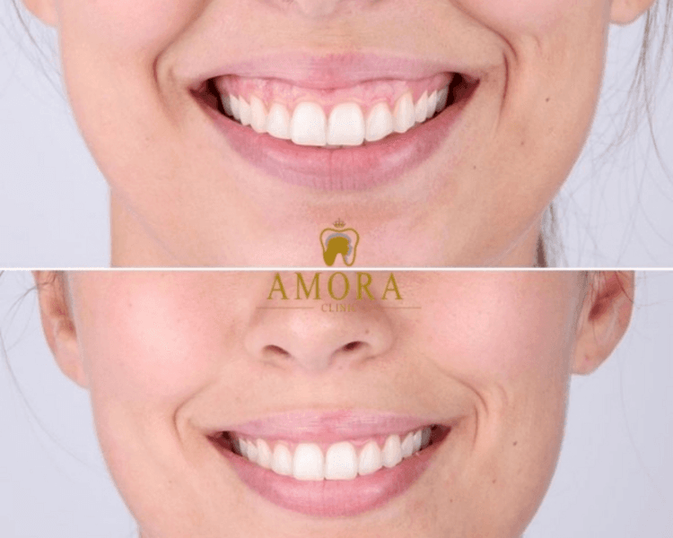 Sonrisa gingival- Miomodulación