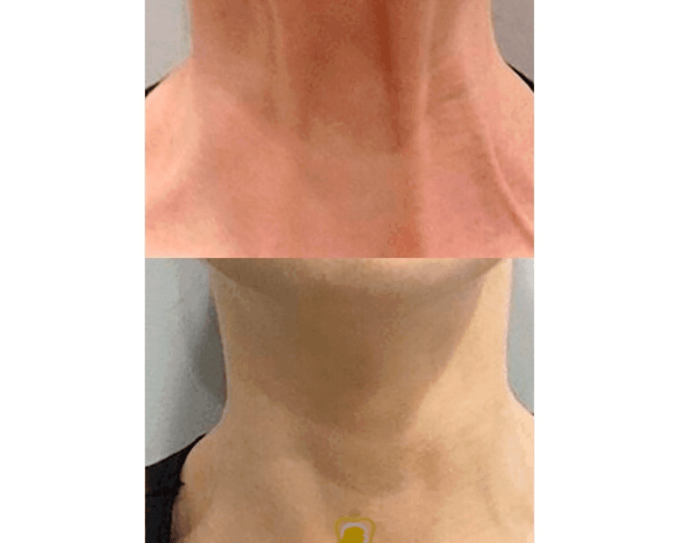 Bandas platismales cuello