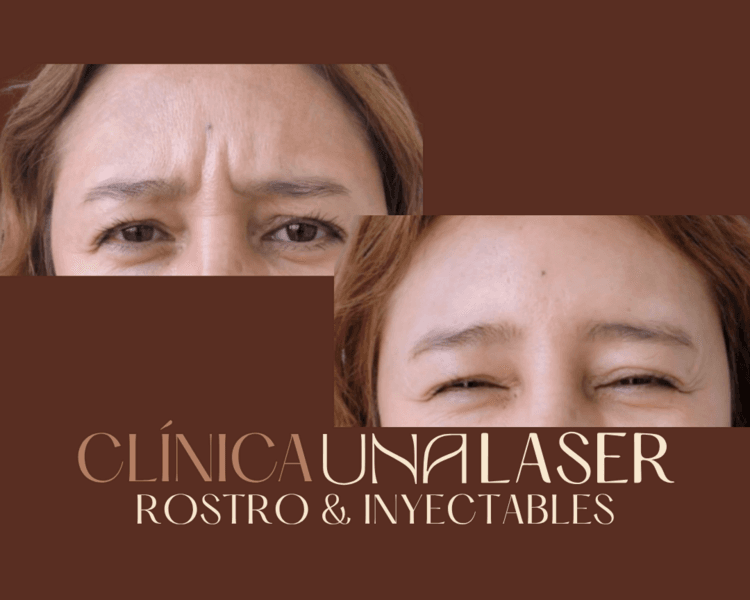 Toxina botulínica (Botox) 1 zona