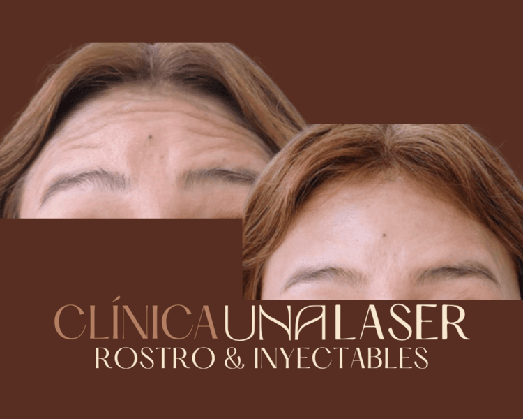 Toxina botulínica (Botox) 3 zonas