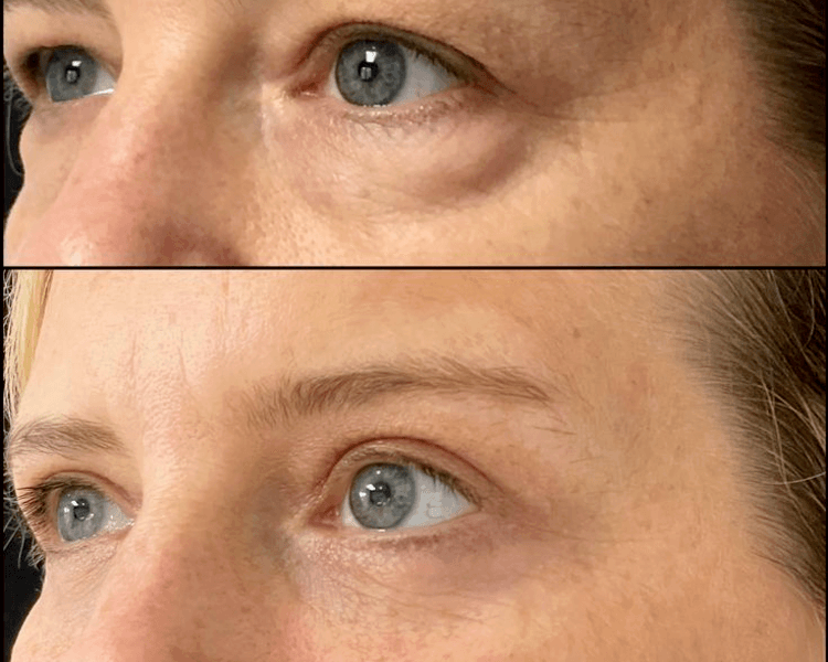 Atenuación bolsas de ojeras - (Pack 3 sesiones)