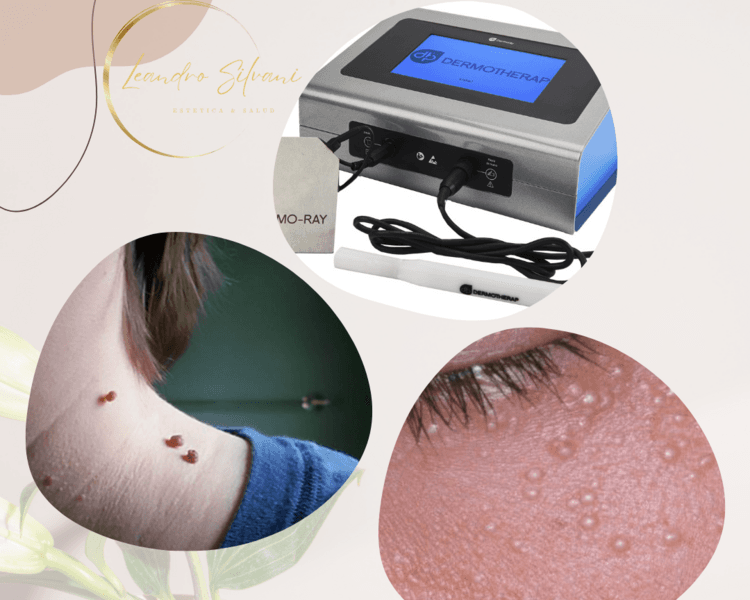 Ablacion de lesion con Laser Plasma (Facial)