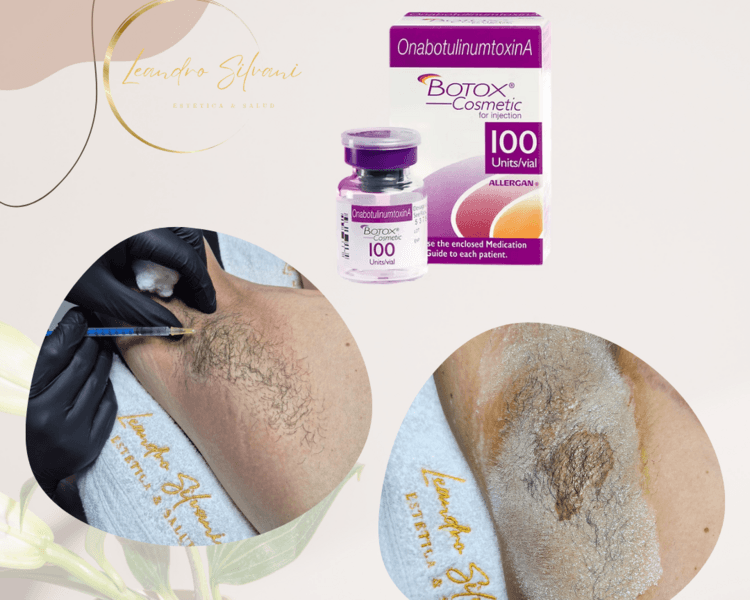 Tratamiento Hiperhidrosis (Botox)