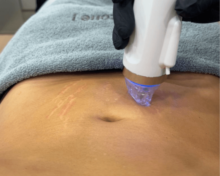 Radiofrecuencia Fraccionada