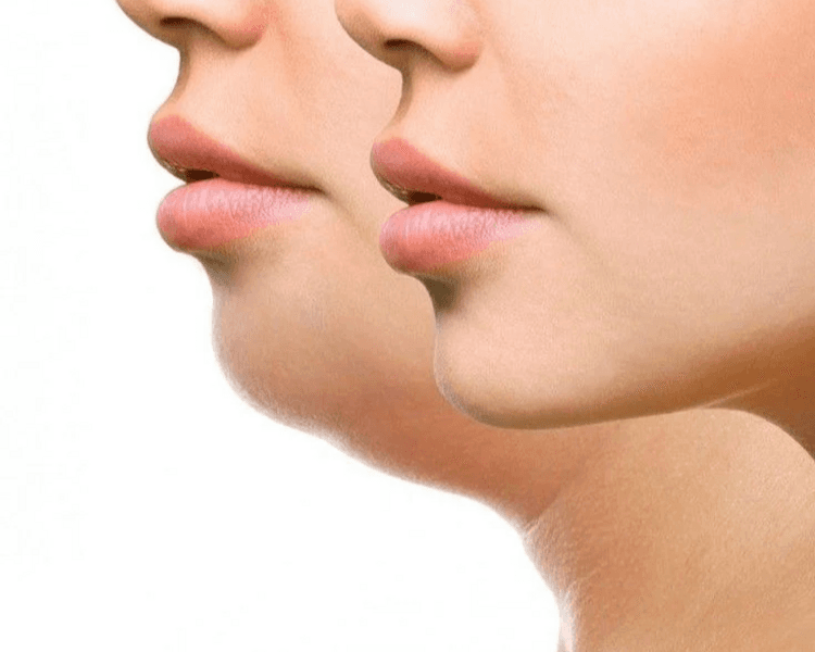 HIFU Facial 12D - Linfting no Invasivo