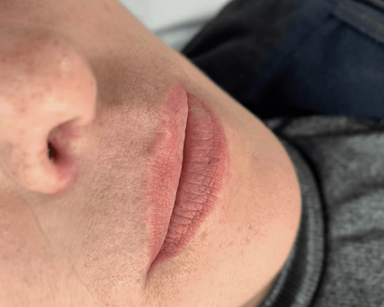 Neutralización de labios oscuros