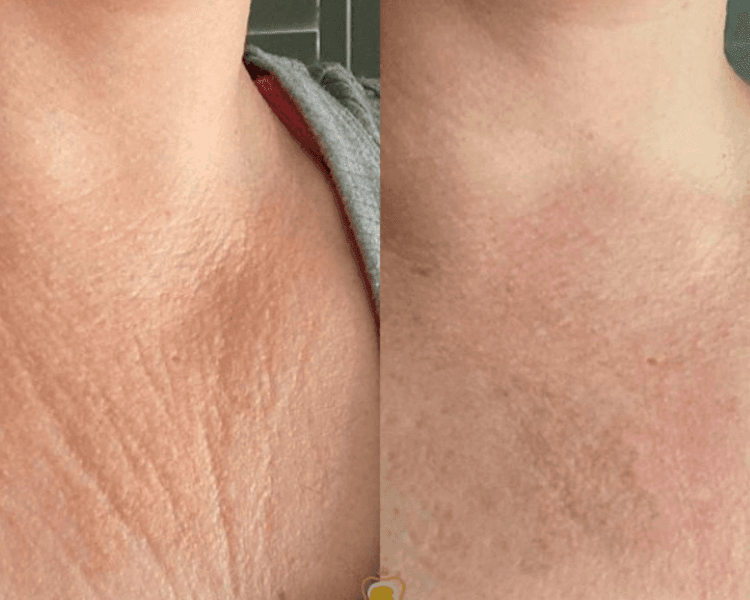 Bioestimulador inyectable Novuma