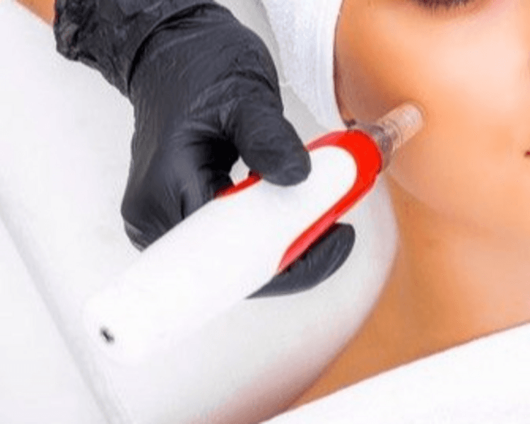 Higiene facial profunda + Microneelding (Dermapen)