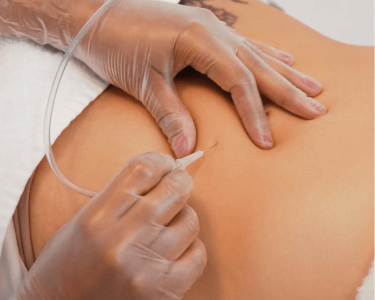 CARBOXITERAPIA ABDOMEN LATERALES Y ESPALDA
