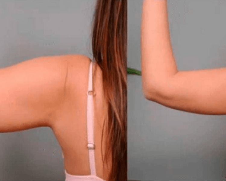 CARBOXITERAPIA BRAZOS