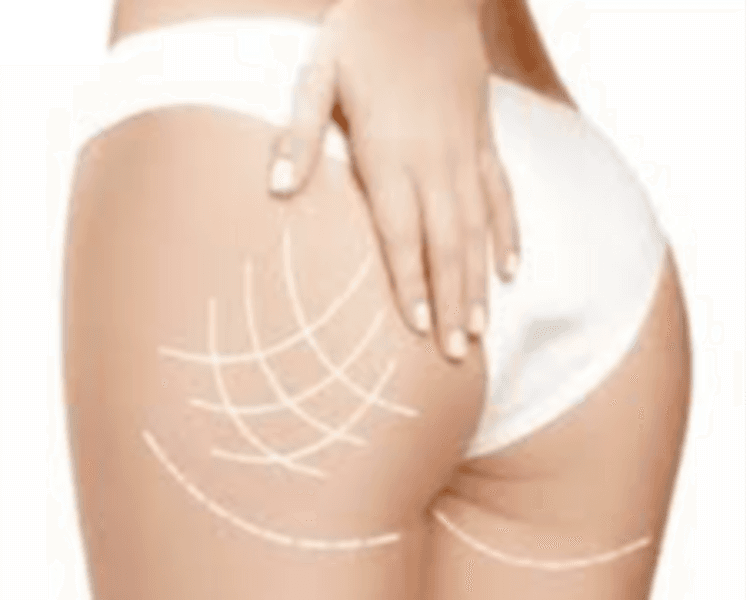 Aumento/ Lifting Glúteos PAQ 5 sesiones