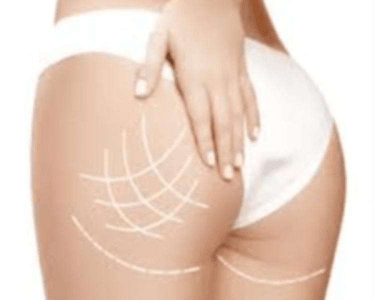 Aumento/ Lifting Glúteos PAQ 5 sesiones