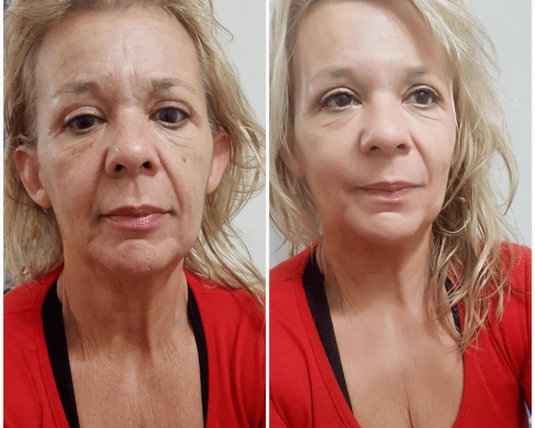 HIFU Facial Completo - efecto lifting sin cirugía (incluye rostro + papada + cuello + contorno mandíbular)
