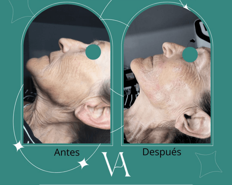 Radiofrecuencia Fraccionada Facial