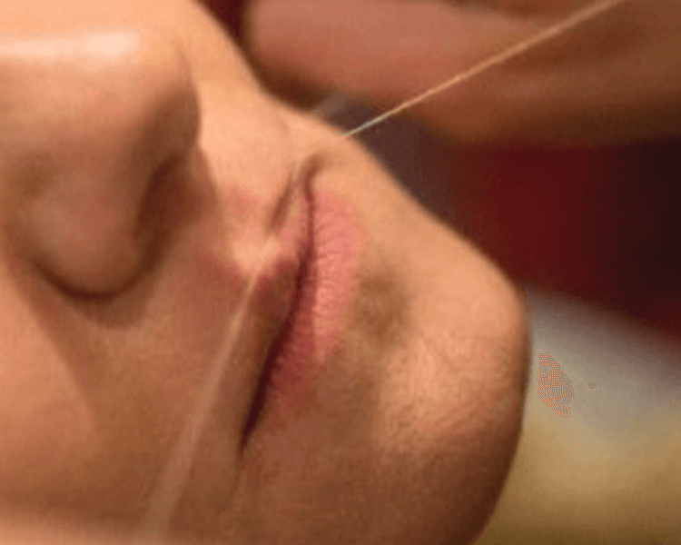 Epilación de Labio Superior