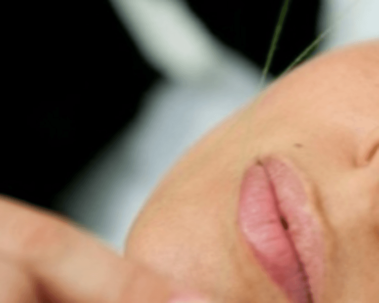 Epilación de Menton