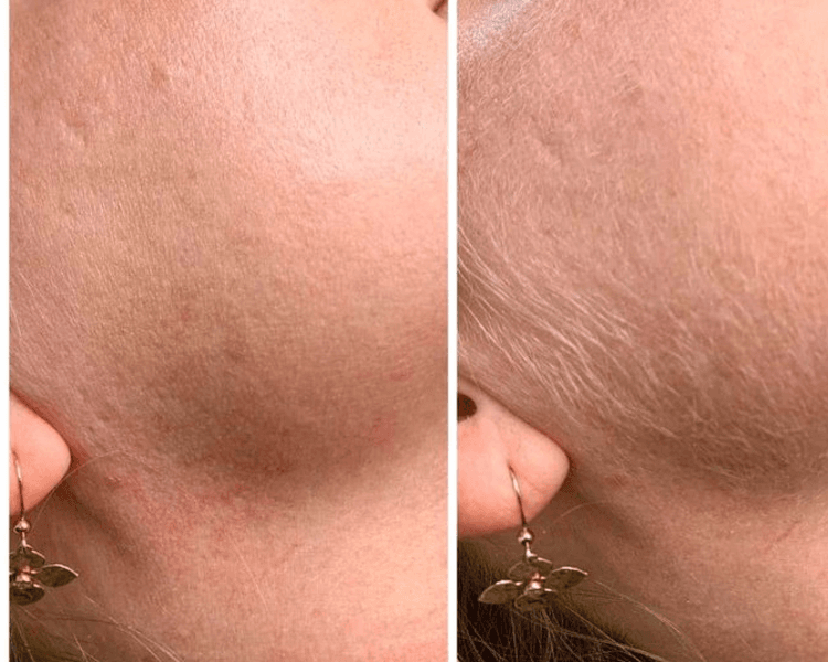 Epilación de Patillas