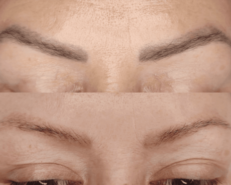 Paquete Remoción Láser Pigmento Cejas (6 Sesiones)