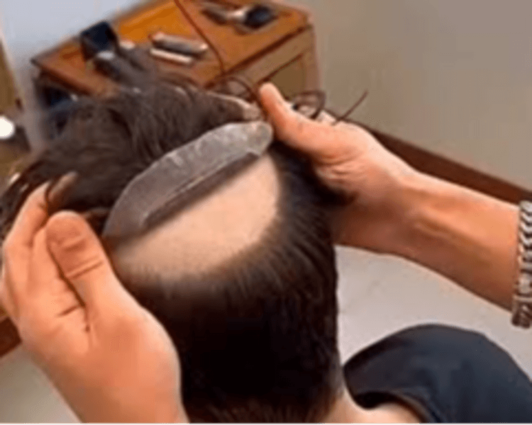 Instalación de Prótesis con Malla Canoso