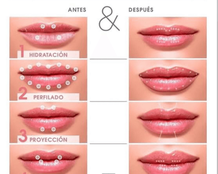 RELLENO ACIDO HIALURONICO