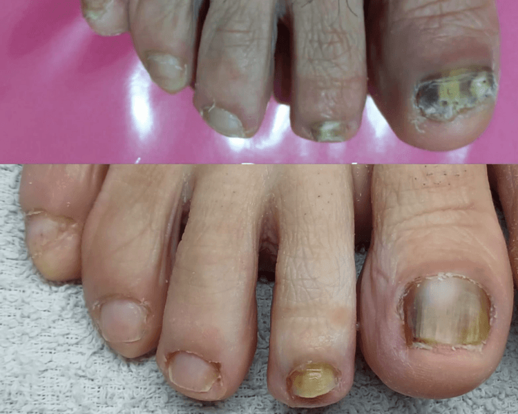 Podología tratamiento antimicótico desde 2 uñas