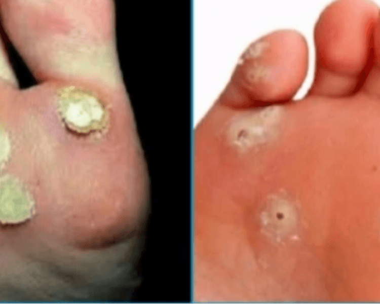 Cauterización de 1-3 Verrugas plantares con Ácido Nítrico