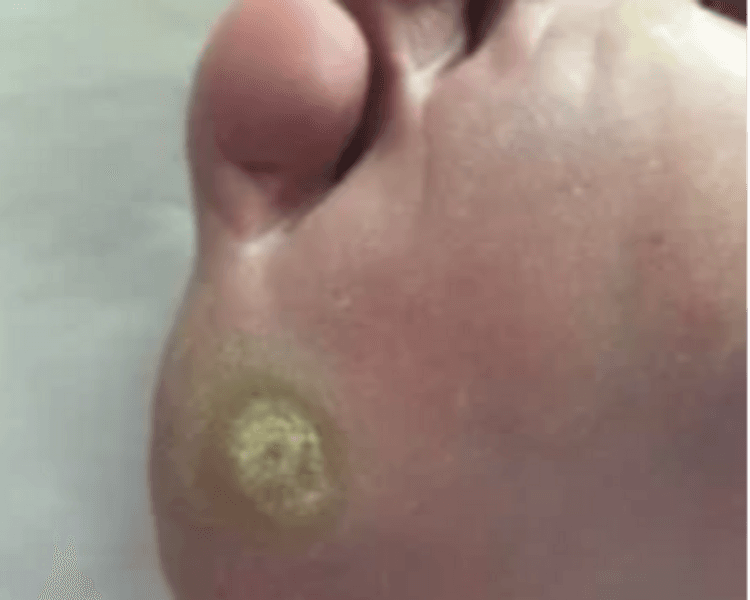 Callos plantares con bisturi