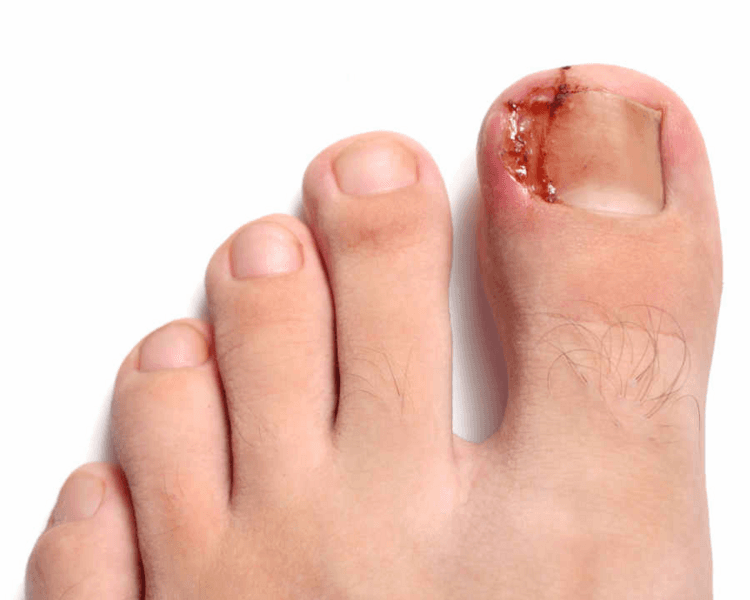 Uña incarnada unilateral