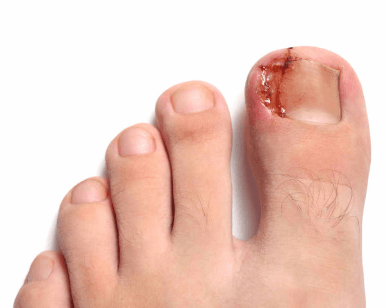 Uña incarnada unilateral(Servicio a domicilio)