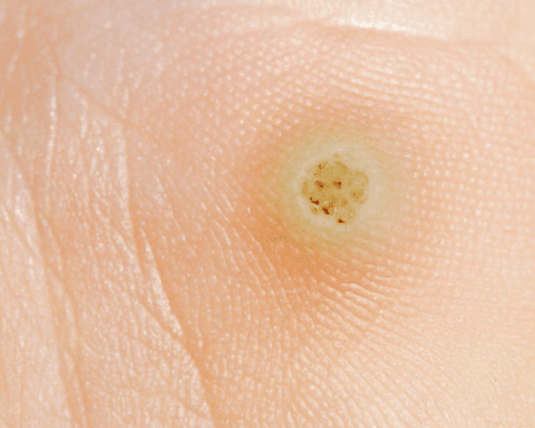 Verrugas plantares por sesión