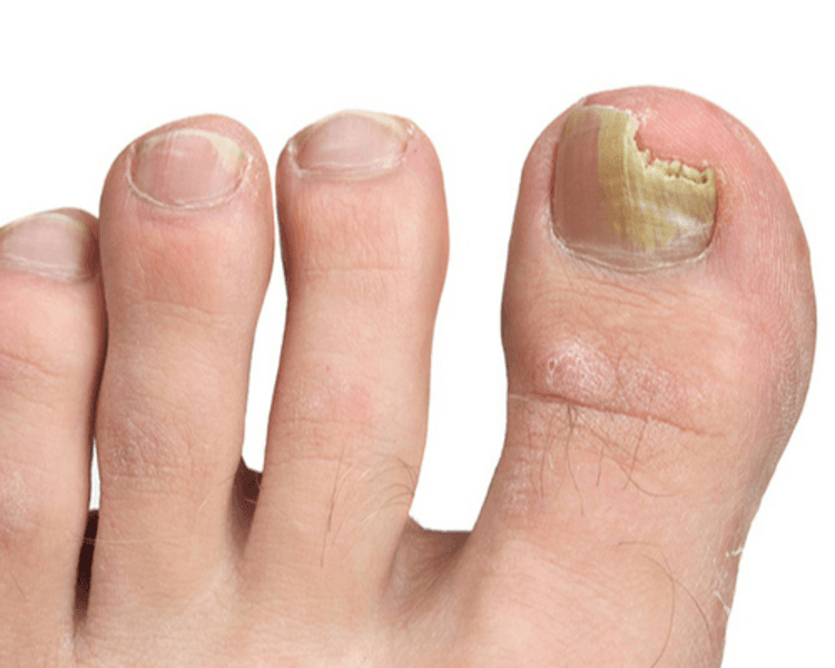 Tratamiento antimicótico