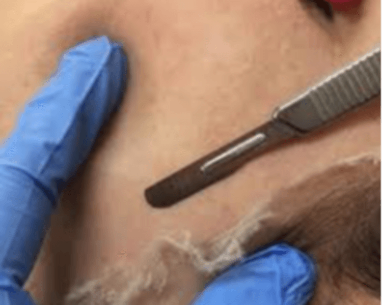 COSMEATRIA: LIMPIEZA FACIAL PROFUNDA CON EXTRACIONES, DERMAPLANING Y DERMAPEN