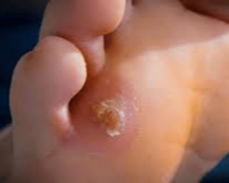 Heloma (ojo de gallo)