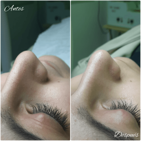 Limpieza Facial Profunda