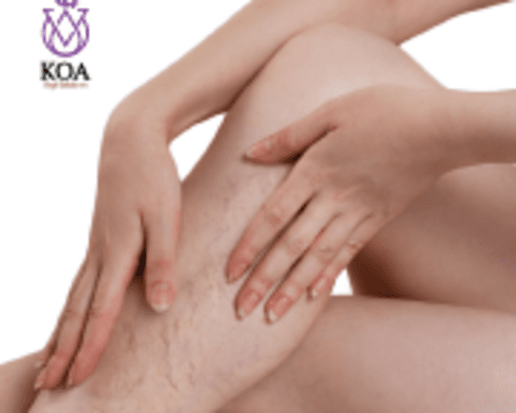 VALORACION ARAÑITAS TELAGIECTASIAS