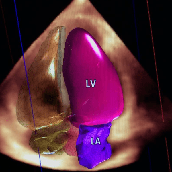 Ecocardiograma doppler (2D y 3D)