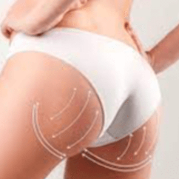 PAQUET LEVANTAMIENTO DE GLUTEOS 10 SESIONES