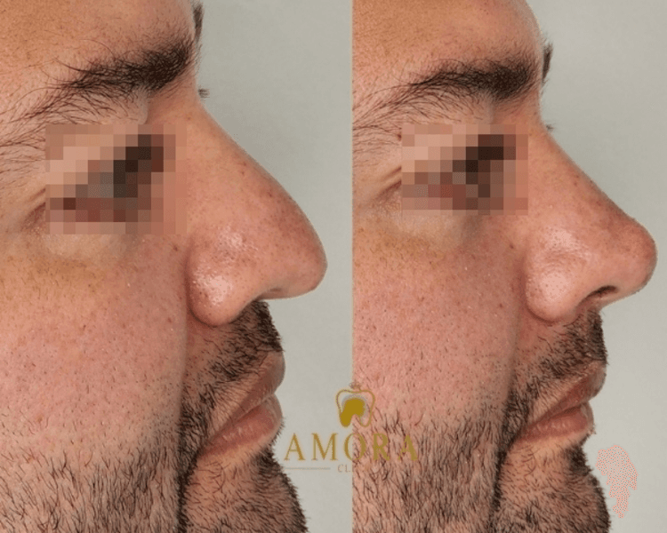 Rinomodelación –$200.000 (M. Hyafilia) / $260.000 (M. Juvederm)