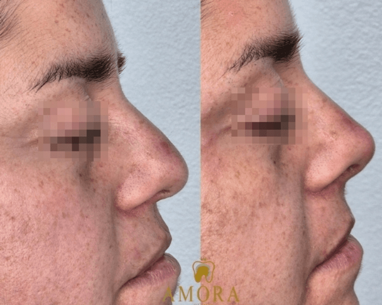Rinomodelación –$180.000 (M. Hyafilia) / $260.000 (M. Juvederm)