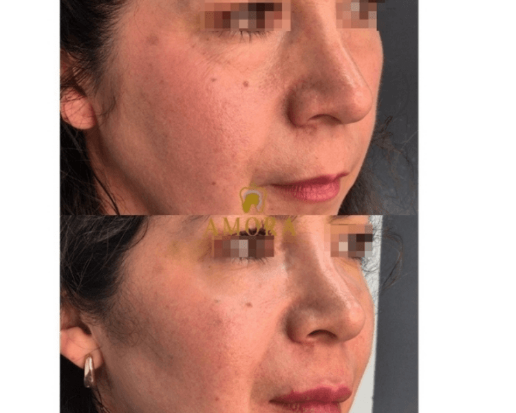 Aumento de pómulos – $200.000 (M. Hyafilia) / $280.000 (M.Juvederm)