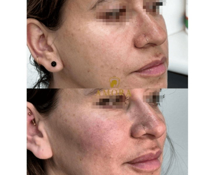 Aumento de pómulos – $200.000 (M. Hyafilia) / $260.000 (M.Juvederm)