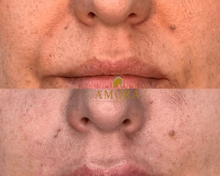 Relleno de surcos nasogenianos –$200.000 (M. Hyafilia)/ $280.000 (M. Juvederm)