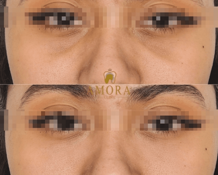 Relleno de ojeras – $200.000 (M. Hyafilia) /$280.000 (M. Juvederm)