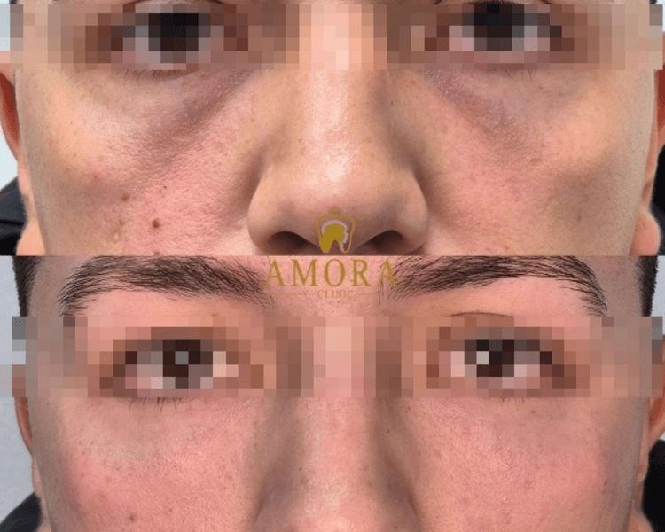 Reposición de mejillas– $200.000 (M. Hyafilia)/ $280.000 (M. Juvederm)