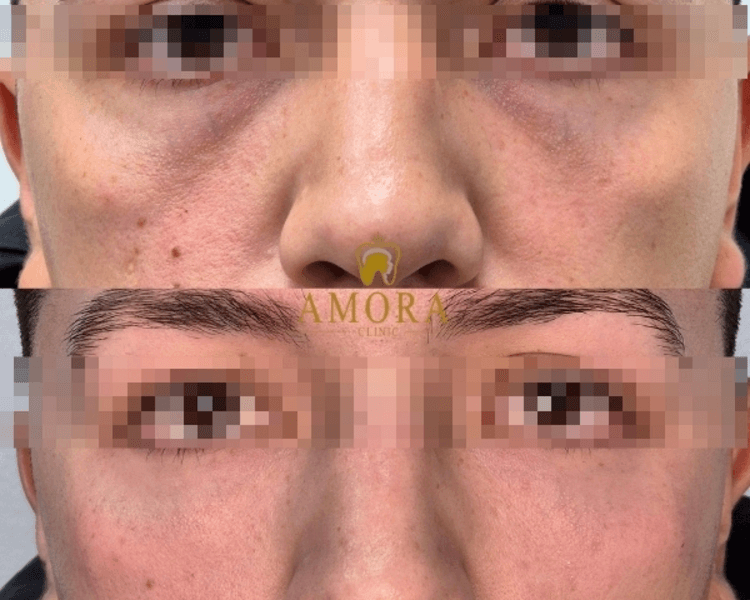 Reposición de mejillas– $200.000 (M. Hyafilia)/ $260.000 (M. Juvederm)