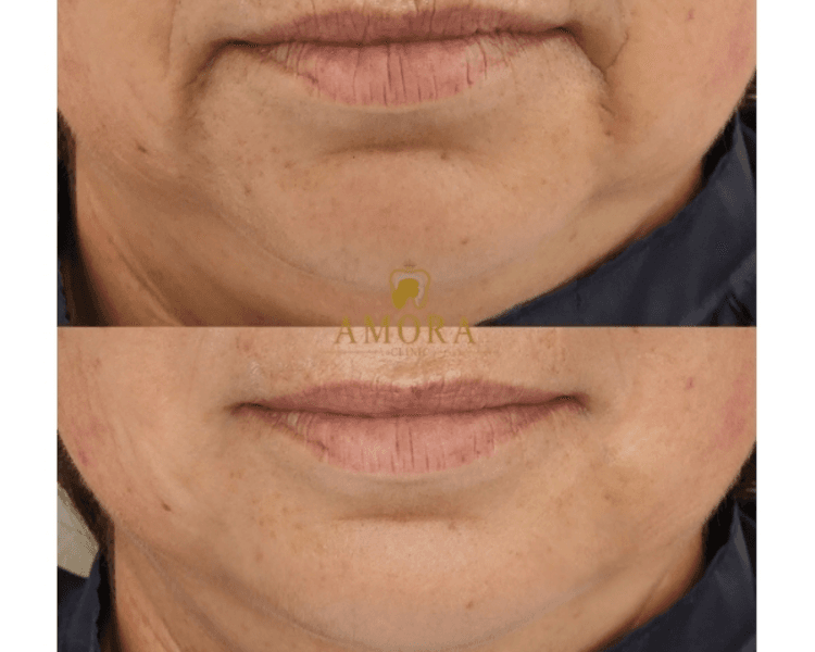 Relleno de líneas de marioneta– $200.000 (M. Hyafilia) /$280.000 (M. Juvederm)